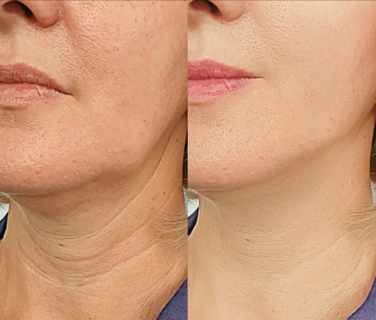 Masajeador Facial Con Terapia Led y Microvibración